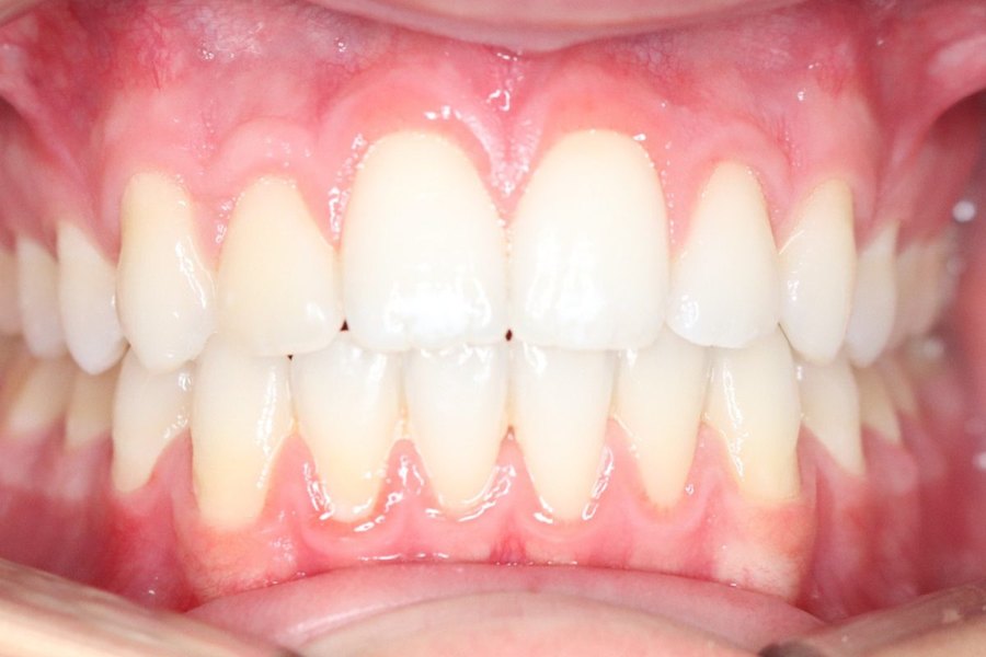 Close-up of the patient&rsquo;s teeth after orthodontic treatment