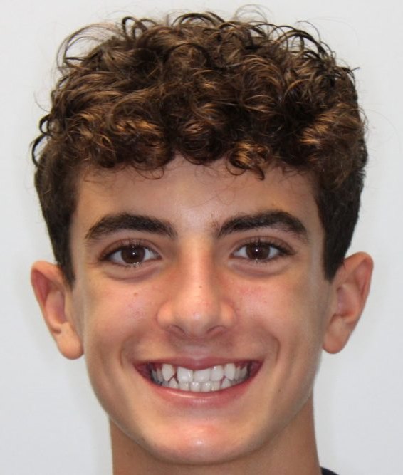 Patient smiling before orthodontic treatment